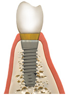 img bonegraft3